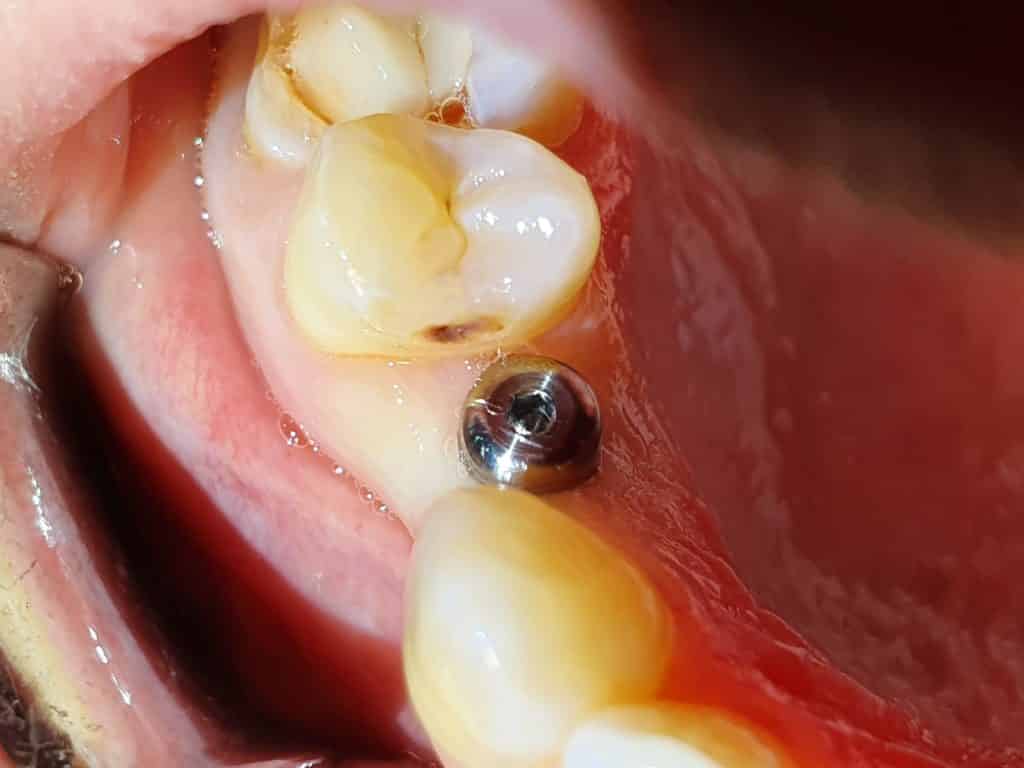 Implant dentaire : quels sont ses avantages ?