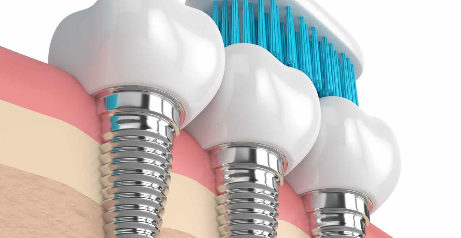 Implant dentaire : quand est-ce que l’implant intervient ?